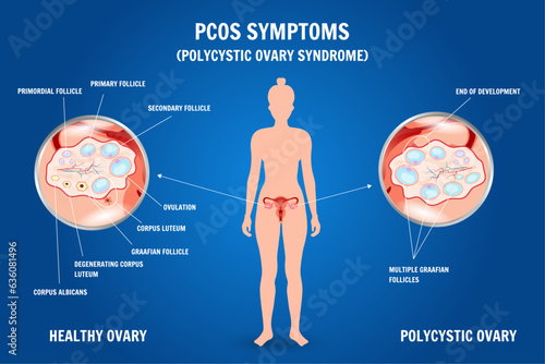 PCOS symptoms, polycystic ovary syndrome medical infographic with zoom in vector photo