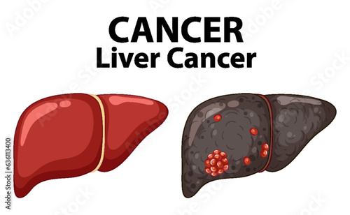 Comparing Healthy and Cancerous Liver Cell Growth