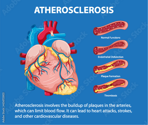 Science Education: Human Anatomy and Atherosclerosis Infographic