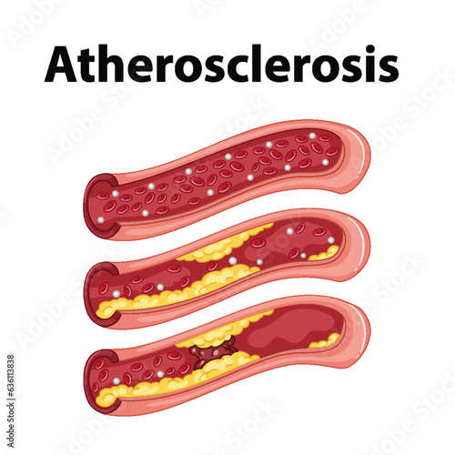 Science Education: Human Anatomy and Atherosclerosis Infographic