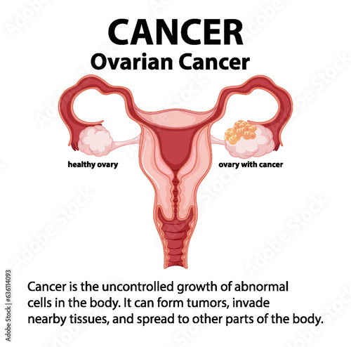 Comparing Normal and Cancerous Ovaries in Medical Anatomy Infographic