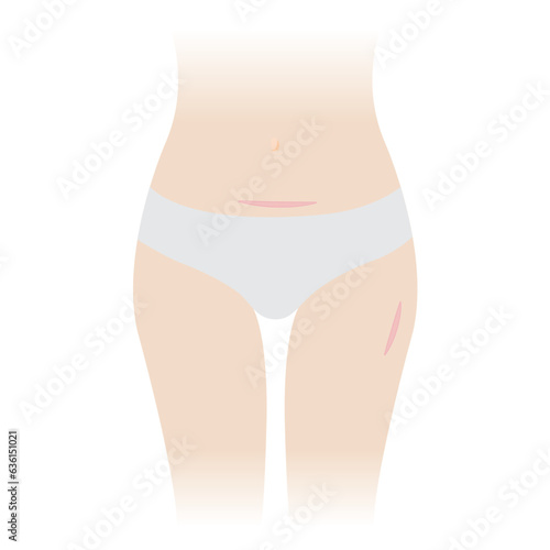 The woman with keloid scars on belly and thigh vector illustration isolated on white background. Keloid scar, raised scar on her body after having a cesarean section, hysterectomy and skin injury.