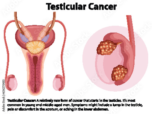 Male Testicular Cancer Anatomy Diagram