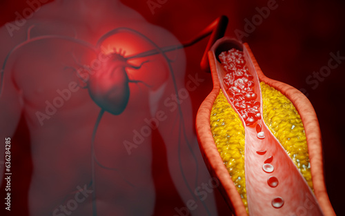 Hyperlipidemia or arteriosclerosis. Blocked artery concept and human blood vessel as a disease with cholesterol fat buildup clogging. Clogged arteries, Cholesterol plaque in the artery. 3D Rendering © Superrider