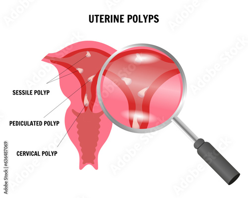 Uterine polyps infographic, womans health, medical disease, sessile polyp, pediculated polyp, cervical polyp