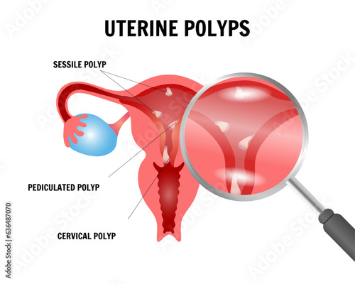 Uterine polyps gynecology infographic, sessile polyp, pediculated polyp, cervical polyp