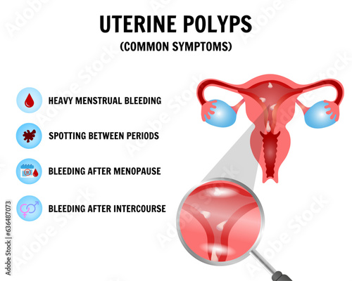 Uterine polyps infographic and medical information, sessile polyp, pediculated polyp, cervical polyp photo