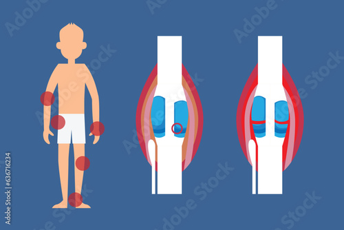 Osteoporosis and bone loss 2d vector illustration concept for banner, website, landing page, flyer, etc
