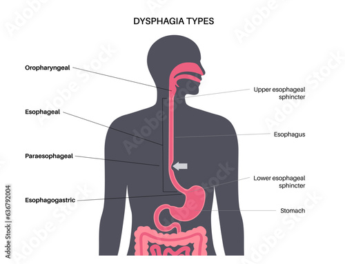 Dysphagia medical poster