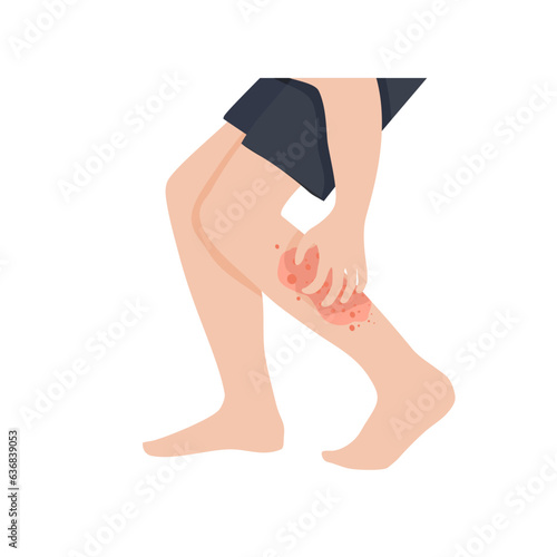 A rash is an area of irritated or swollen skin. Many rashes are itchy, red, painful, and irritated. Some rashes can also lead to blisters or patches of raw skin.