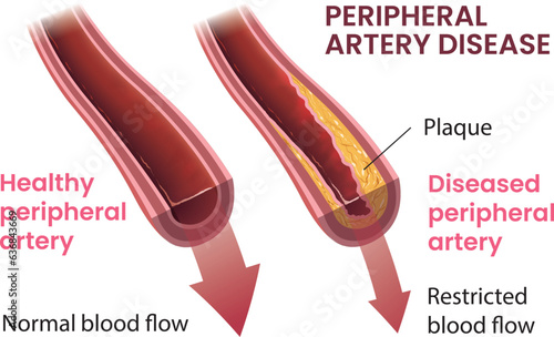 illustration of peripheral artery disease infographic vector