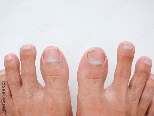 Toes with nail disease isolated on a white background photo