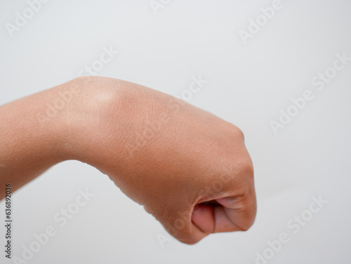 Obraz na plátně ganglion cyst on woman hand isolated on white background