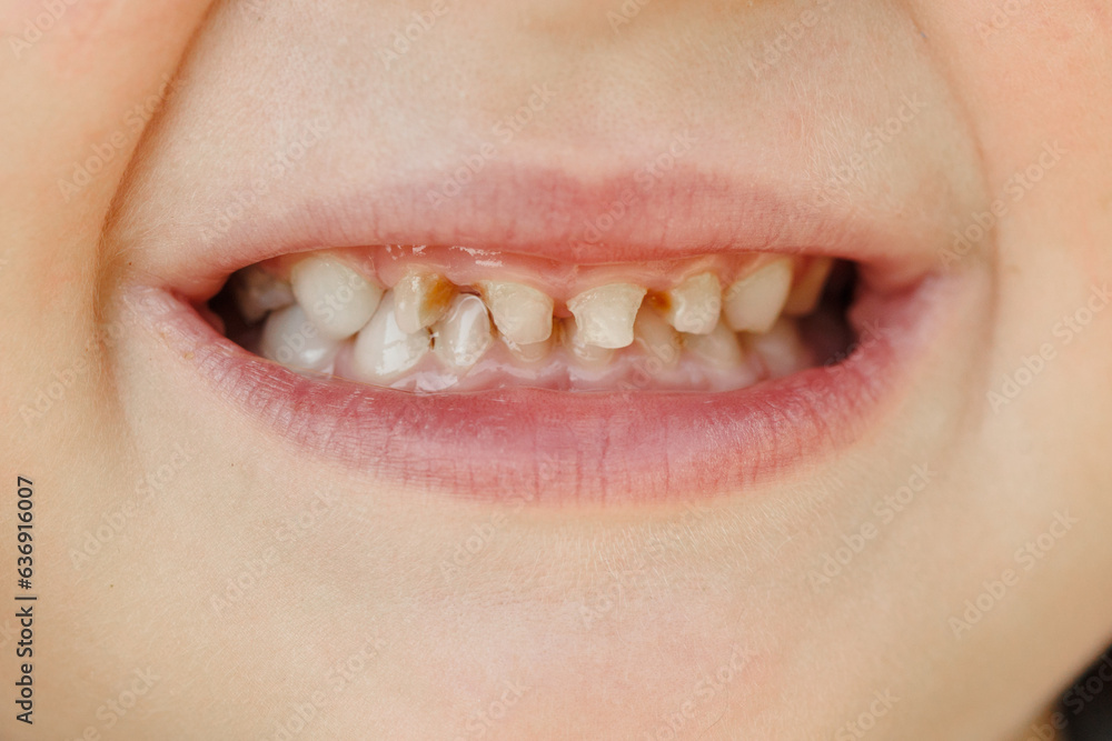 Obraz premium Children's milk teeth with caries. Close-up of unhealthy milk teeth. Dental medicine and healthcare - patient's open mouth showing caries. Children's dentist.
