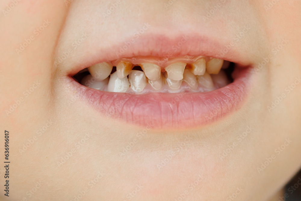 Children's milk teeth with caries. Closeup of unhealthy milk teeth