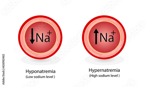 Hypernatremia, high plasma sodium level and Hyponatremia, low plasma sodium level. Sodium Na excess and deficit electrolyte disorders, blood test tube, Scientific design. Vector illustration.