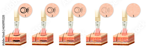 Laser tattoo removal in skin layers before and after. Dark ink absorb light and break down.