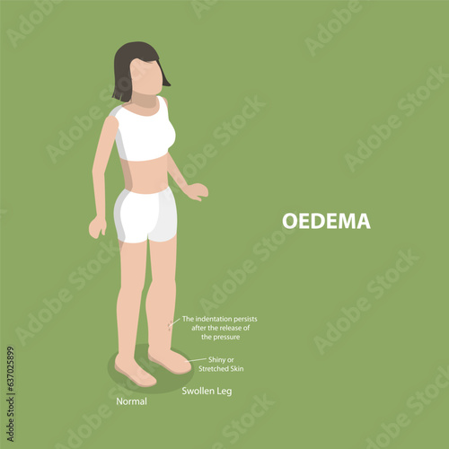 3D Isometric Flat Vector Conceptual Illustration of Oedema, Swollen Ankles and Feet