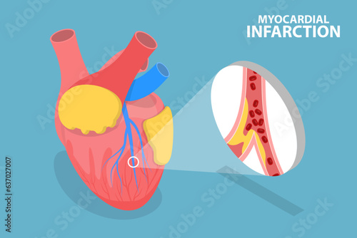 3D Isometric Flat Vector Conceptual Illustration of Myocardial Infarction, Heart Attack photo