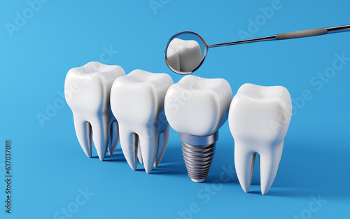 Dental teeth implants and Healthy white tooths  dentist mirror  Oral health and dental inspection teeth. Medical dentist tool  children healthcare  3D render