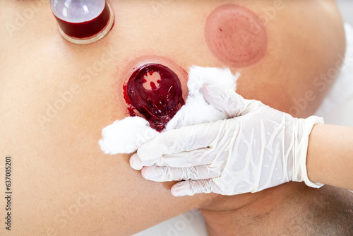 Blood cleaning process after hijama or wet cupping treatment. photo