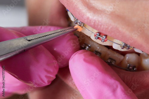 Dental procedure for installing braces close up.The procedure for the care of teeth and gums in the mouth.
