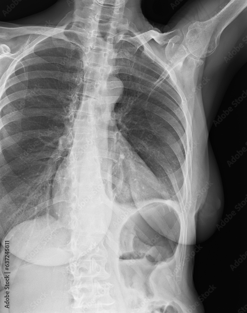 Costal x-ray of coast sternum and clavicle Costal x-ray of coast sternum and clavicle
