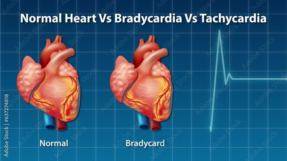 bradycardia gabapentin