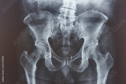 Hip xray. Gold thread attached on the bone. Cancer treatment