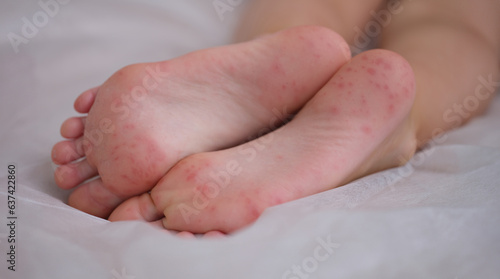 Eczema is an irritation caused by an allergic lesion of skin of feet in child. Infectious skin diseases in children