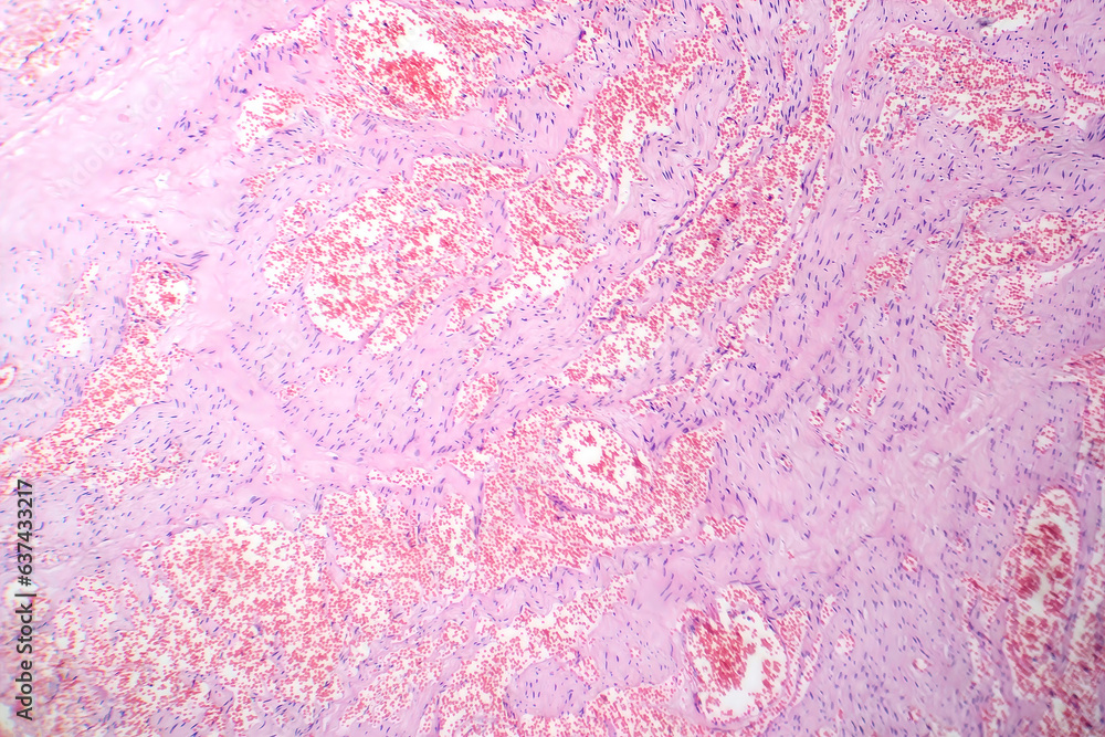 Capillary hemangioma, light micrograph ภาพถ่ายสต็อก Adobe Stock