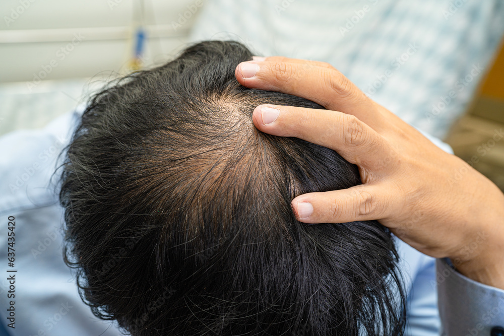 Bald in the middle head and begin no loss hair glabrous of mature Asian business smart active office man. Bald in the middle head and begin no loss hair glabrous of mature Asian business smart active office man.