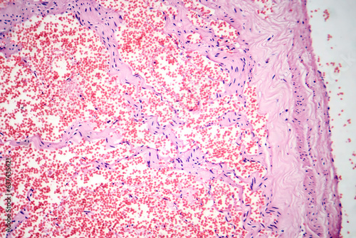 Obraz na płótnie Capillary hemangioma, light micrograph