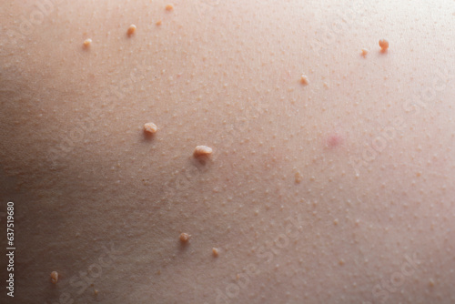 Several warts on the body close-up. photo