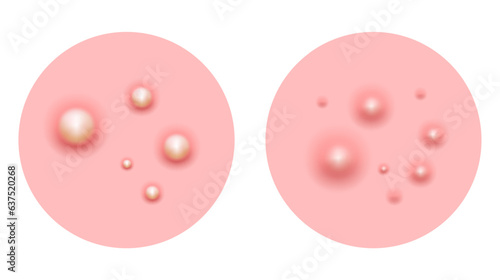 Acne skin pimple, vector illustration