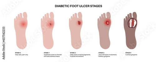 Diabetic Foot Ulcers