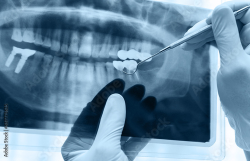 Dentist examining a panoramic dental x-ray photo