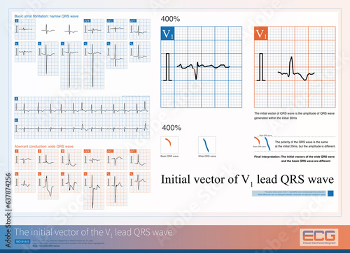 Canvas Print When a wide QRS wave occurs, the same initial vector of the V1 lead QRS wave indicates aberrant conduction, while differences cannot distinguish between ventricular and aberrant conduction beats