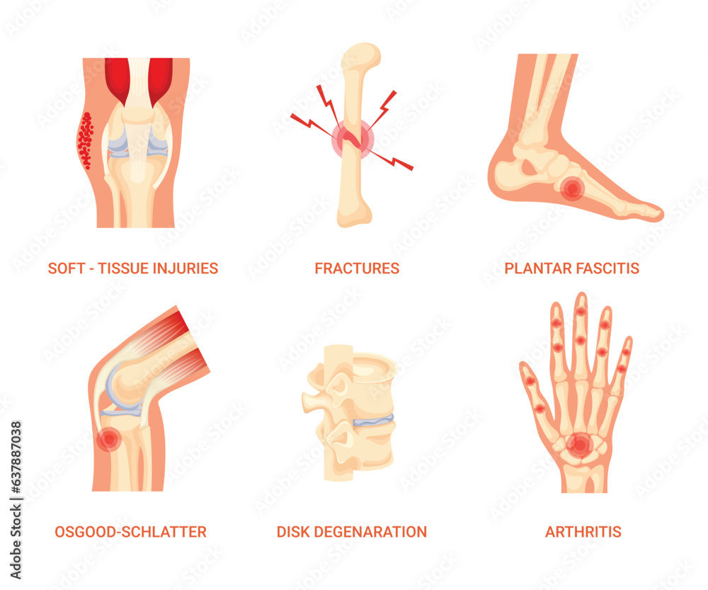 Set of Bones Disease, Soft-Tissue Injuries Disease, Fracture Disease ...