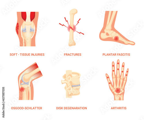 Set of Bones Disease, Soft-Tissue Injuries Disease, Fracture Disease, Plantar Fasciitis Disease, Osgood-Schlatter Disease, Degenerative Disc Disease, Arthritis Disease
