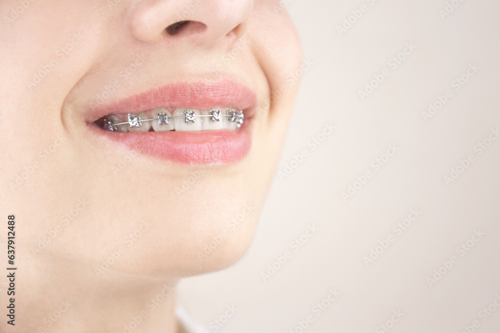 Obraz premium Portrait of a young girl with braces. Orthodontics, dentistry.