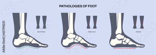 Foot pathologies poster