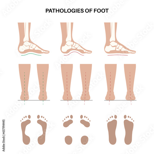 Foot pathologies poster