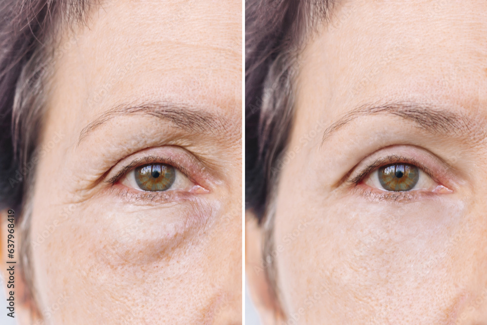 Elderly caucasian woman's face with puffiness under her eyes and wrinkles before and after treatment. Age-related skin changes, fatigue. Result of blepharoplasty plastic surgery.Rejuvenation procedure - obrazy, fototapety, plakaty 
