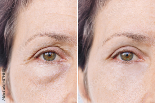 Elderly caucasian woman's face with puffiness under her eyes and wrinkles before and after treatment. Age-related skin changes, fatigue. Result of blepharoplasty plastic surgery.Rejuvenation procedure