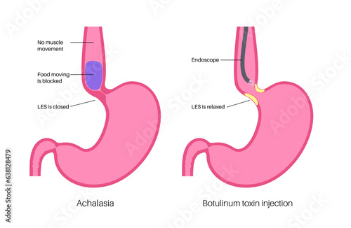 esophageal botulinum toxin injection