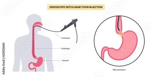 esophageal botulinum toxin injection