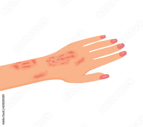 Female hand with serious burn injury