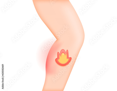 Heat in calves. Calves ache, pains, and hot like burning. symptoms of the disease. problems or disorders in the muscles or nerves. health issues. Minimalist 3D illustration design. vector elements