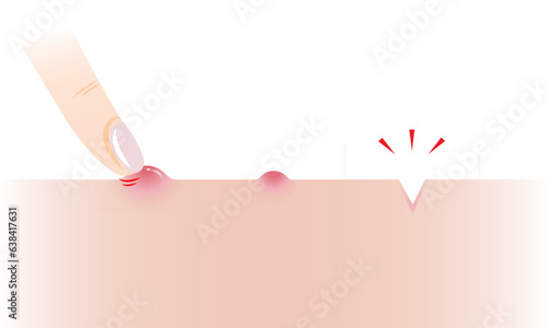 Step of popping pimple to icepick scar vector illustration on white background. The inflammatory acne, papule on skin, squeezing pimple with finger to acne scar. Before and after skin care concept.